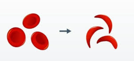 India Unveils Indigenous Gene Therapy for Sickle Cell Disease